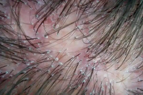 Dermatitis del cuero cabelludo